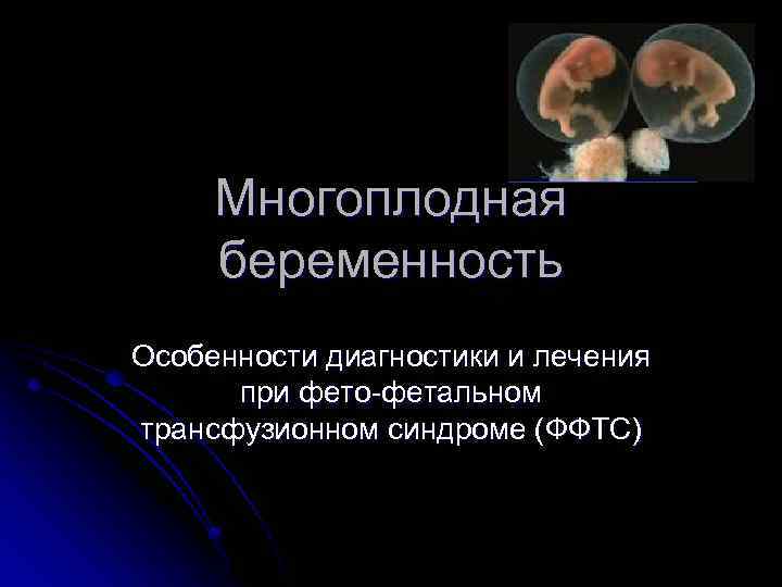 Многоплодная беременность Особенности диагностики и лечения при фето-фетальном трансфузионном синдроме (ФФТС) 
