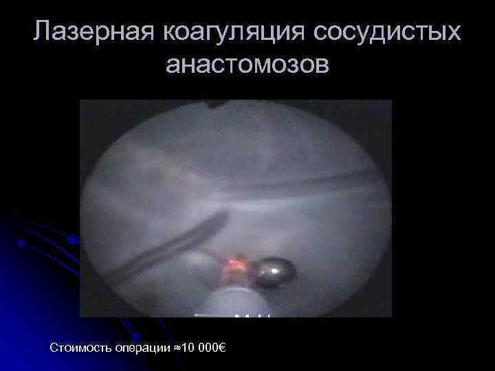 Лазерная коагуляция сосудистых анастомозов Стоимость операции ≈10 000€ 