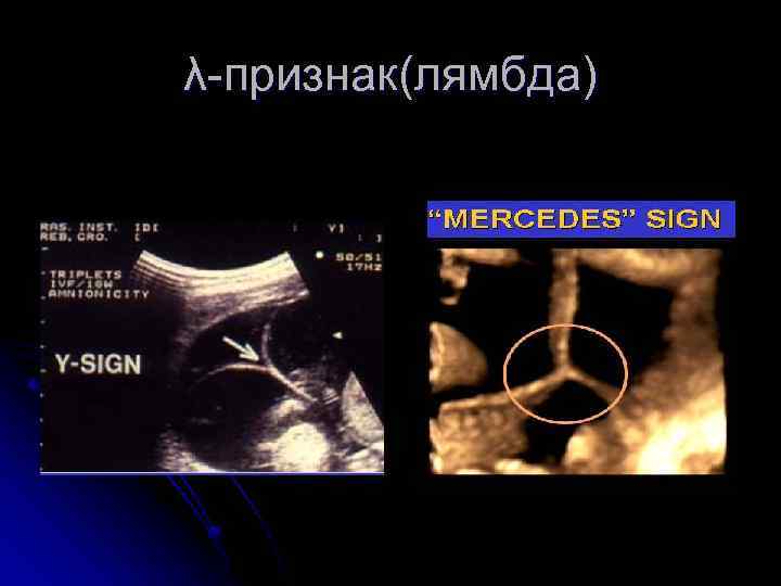 λ-признак(лямбда) 