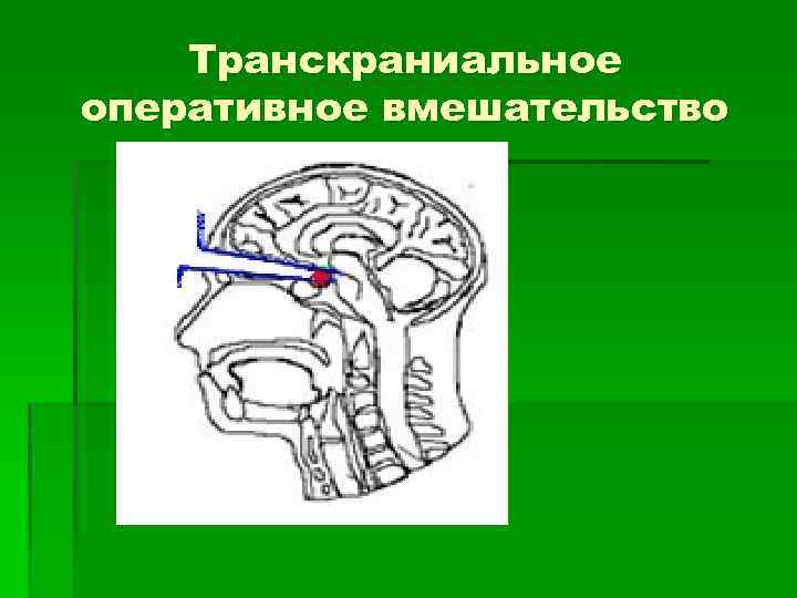 Транскраниальное оперативное вмешательство 