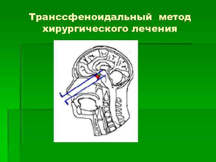 Транссфеноидальный метод хирургического лечения 