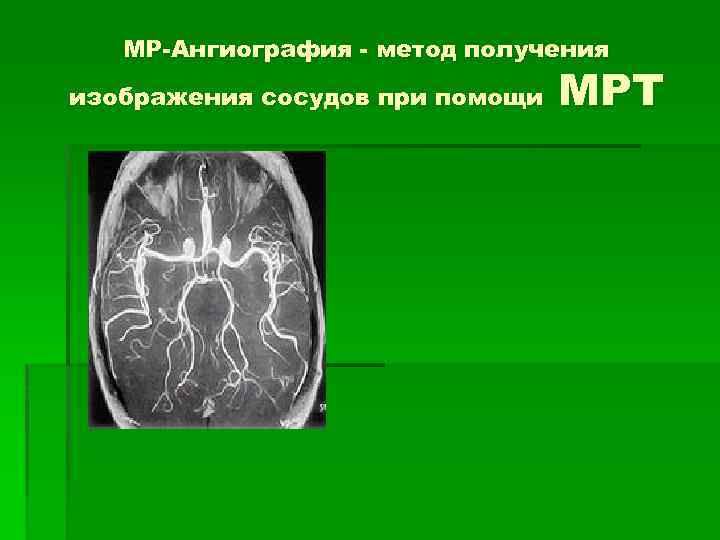 МР-Ангиография - метод получения изображения сосудов при помощи МРТ 