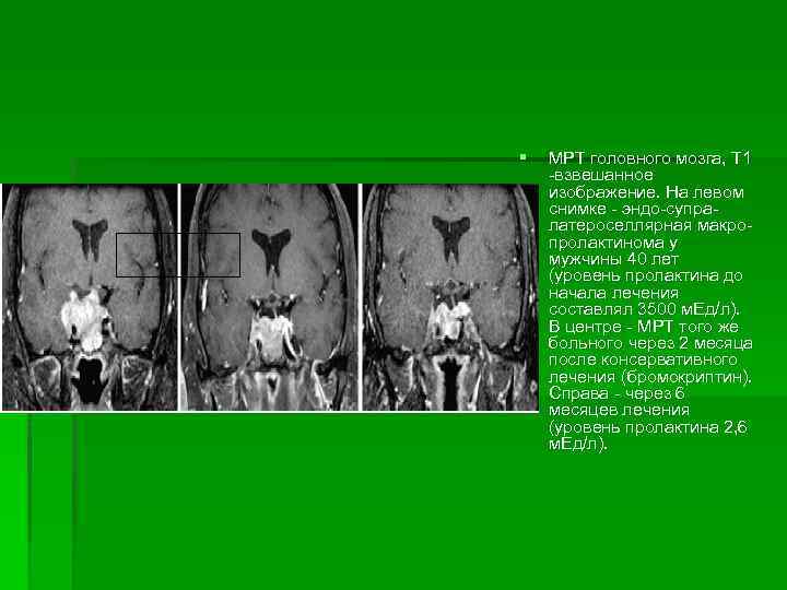 § МРТ головного мозга, Т 1 -взвешанное изображение. На левом снимке - эндо-супралатероселлярная макропролактинома