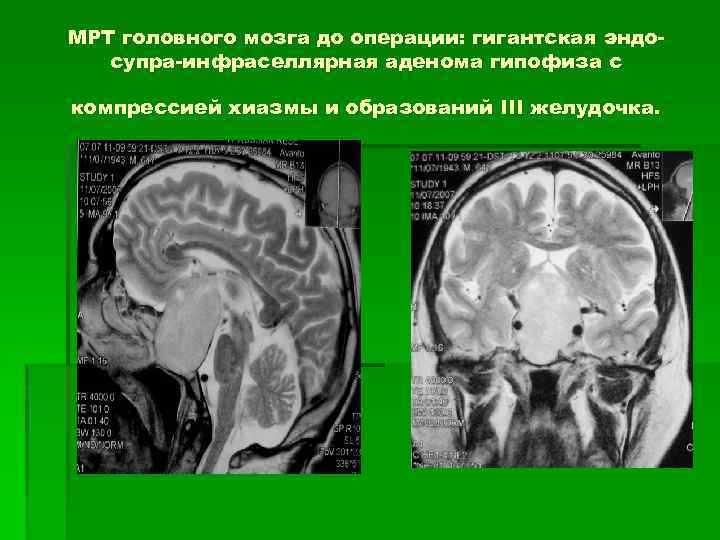 Мрт головного гипофиза. Инфраселлярная аденома гипофиза мрт. Супраселлярная аденома гипофиза мрт. Мрт головного мозга аденома гипофиза. Образование гипофиза на кт.