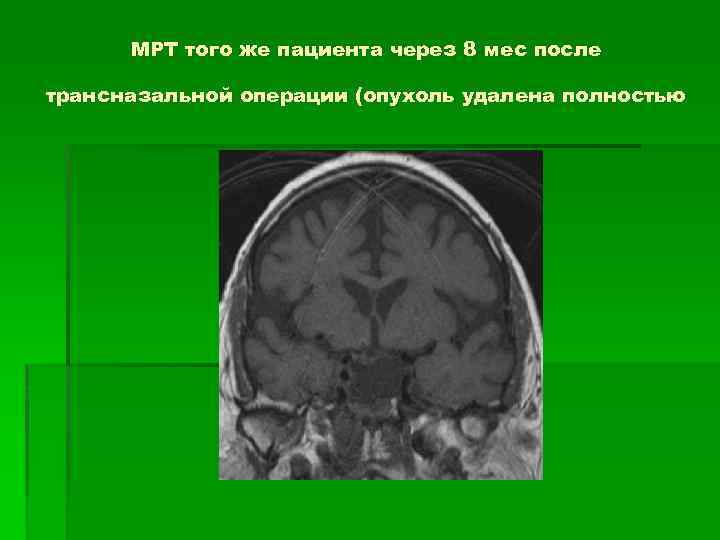 МРТ того же пациента через 8 мес после трансназальной операции (опухоль удалена полностью 