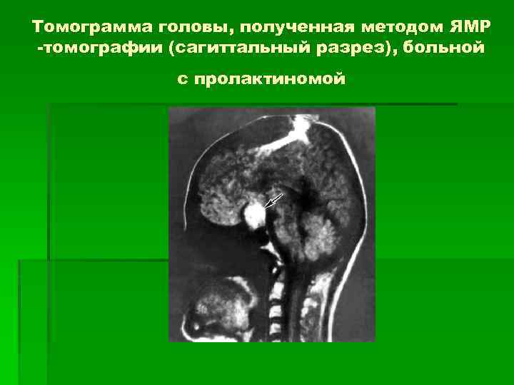 Томограмма головы, полученная методом ЯМР -томографии (сагиттальный разрез), больной с пролактиномой 