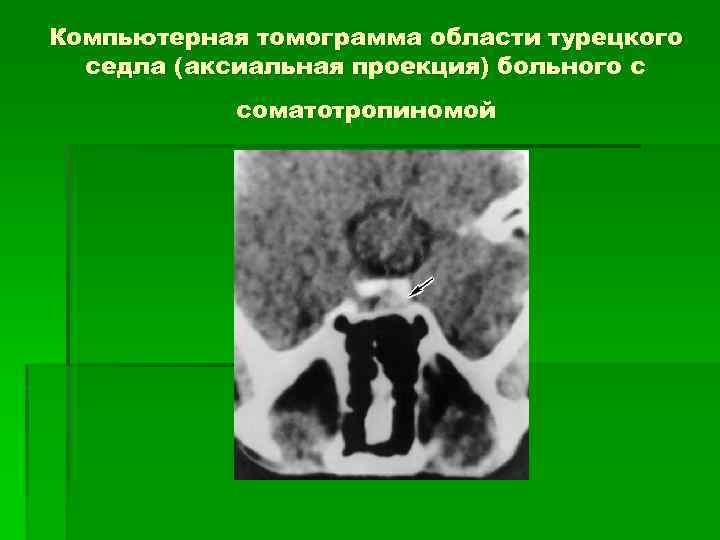 Компьютерная томограмма области турецкого седла (аксиальная проекция) больного с соматотропиномой 