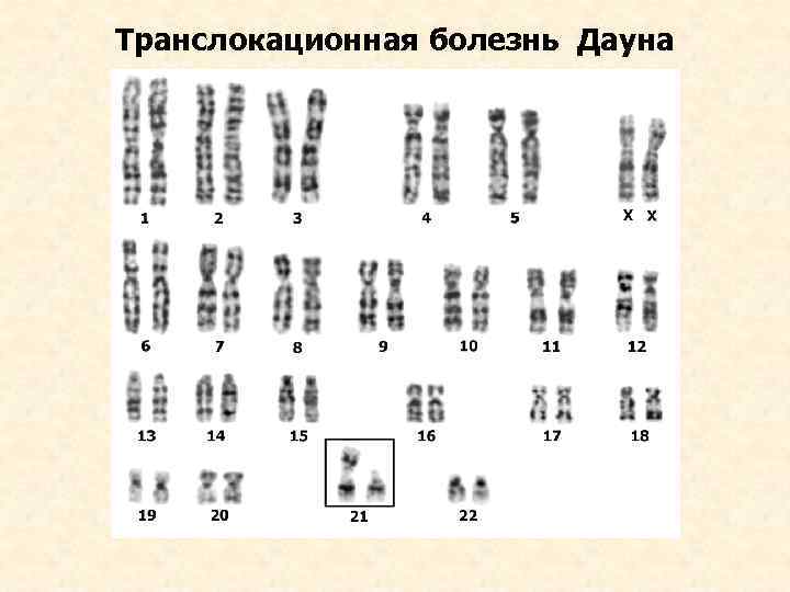 Транслокационная болезнь Дауна 