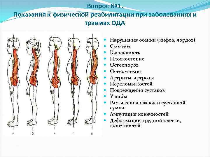 Вопрос № 1. Показания к физической реабилитации при заболеваниях и травмах ОДА Нарушения осанки