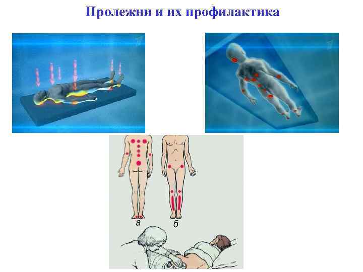 Пролежни и их профилактика 