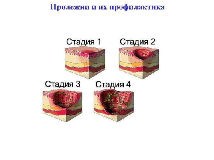 Пролежни и их профилактика 