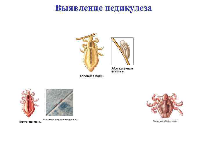 Выявление педикулеза 