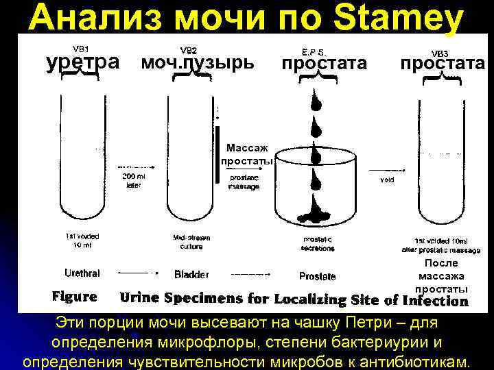 Анализ мочи по Stamey уретра моч. пузырь простата Массаж простаты После массажа простаты Эти