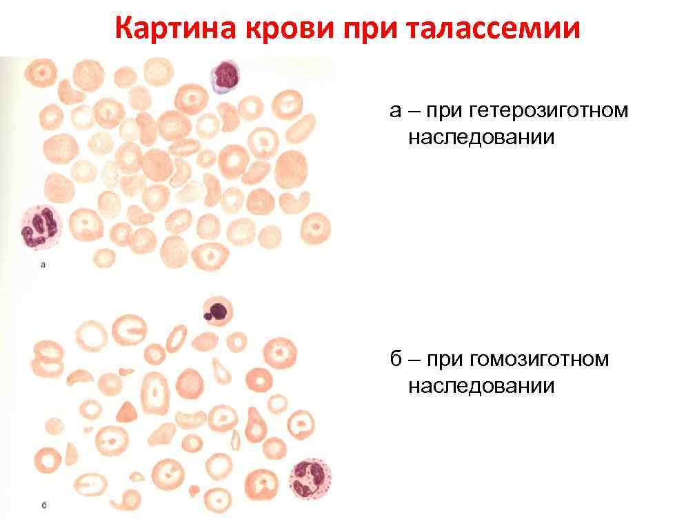 Картина крови при талассемии а – при гетерозиготном наследовании б – при гомозиготном наследовании