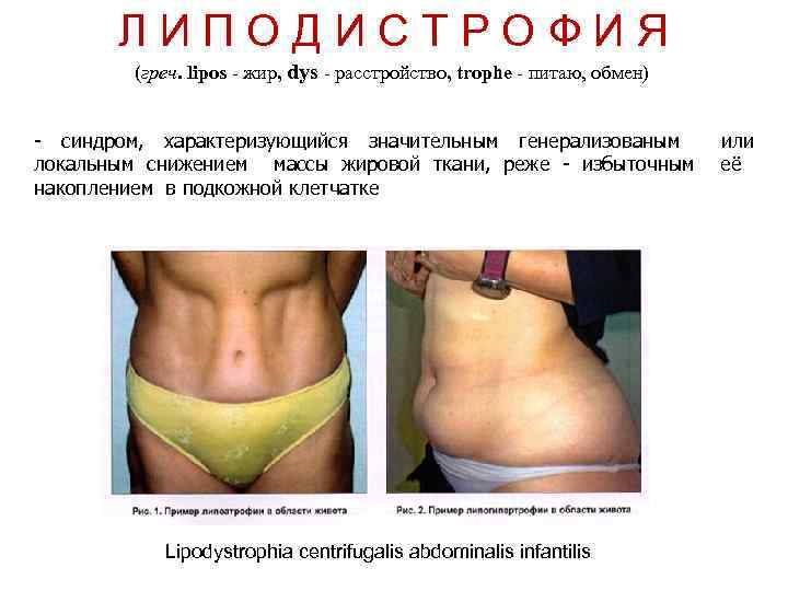 Л И П О Д И С Т Р О Ф И Я (греч.