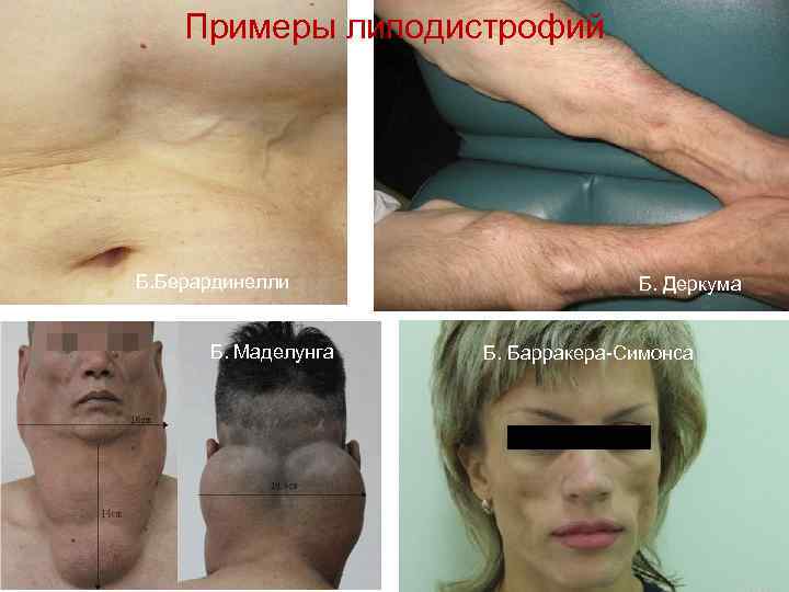 Примеры липодистрофий Б. Берардинелли Б. Маделунга Б. Деркума Б. Барракера-Симонса 