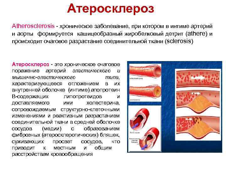 Атеросклероз Atherosclerosis - хроническое заболевание, при котором в интиме артерий и аорты формируется кашицеобразный