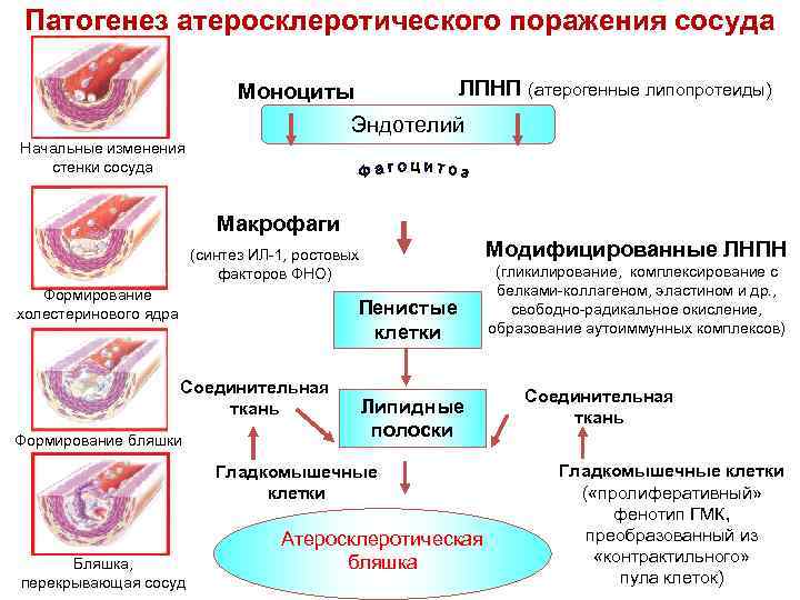 Атеросклеротическое поражение