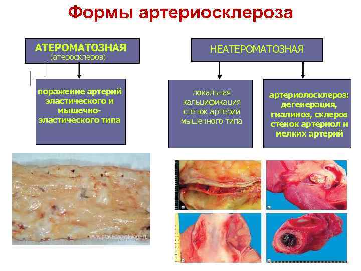 Формы артериосклероза АТЕРОМАТОЗНАЯ (атеросклероз) поражение артерий эластического и мышечноэластического типа НЕАТЕРОМАТОЗНАЯ локальная кальцификация стенок
