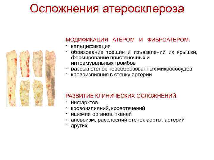 Осложнения атеросклероза 