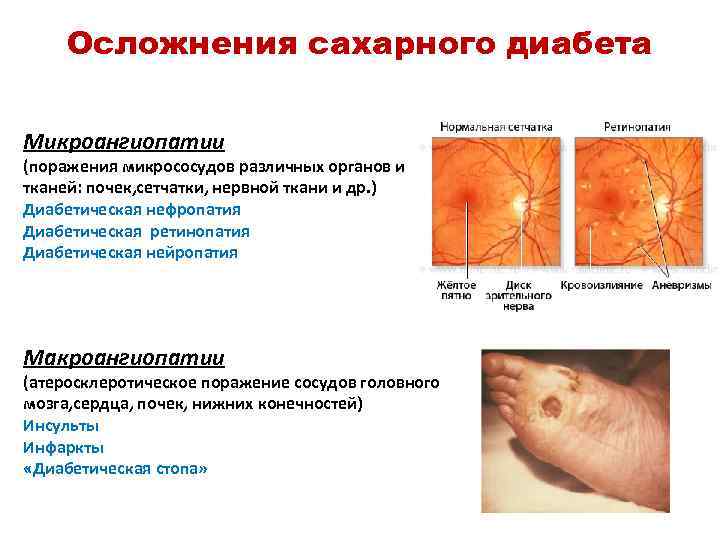 Осложнения сахарного диабета Микроангиопатии (поражения микрососудов различных органов и тканей: почек, сетчатки, нервной ткани