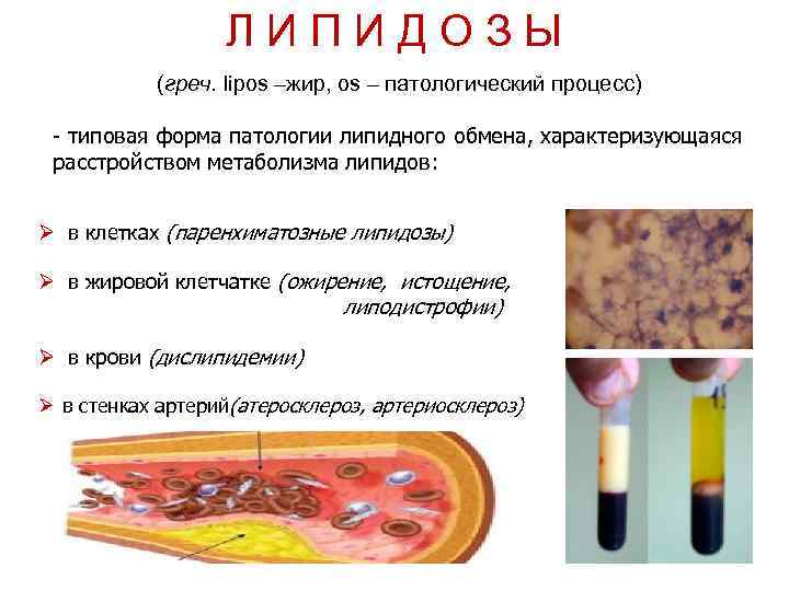 Л И П И Д О З Ы (греч. lipos –жир, os – патологический