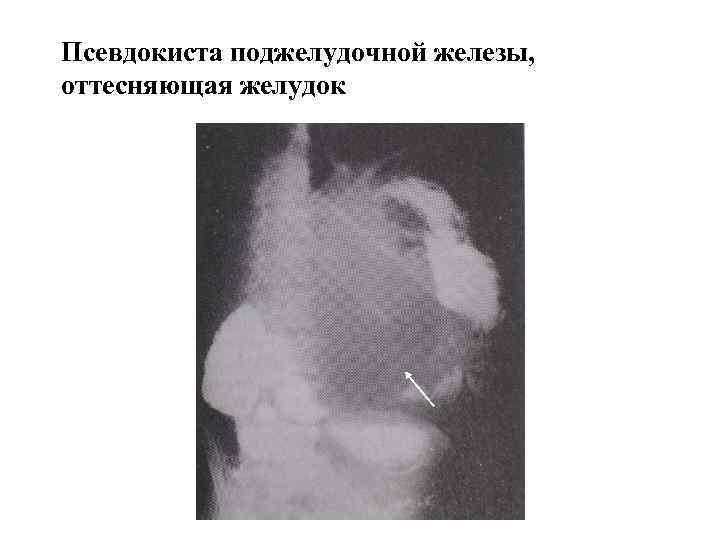 Псевдокиста поджелудочной железы, оттесняющая желудок 