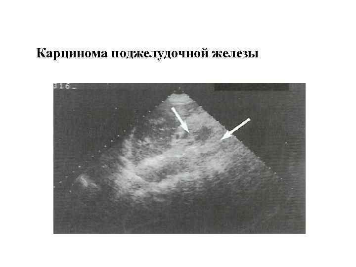 Карцинома поджелудочной железы 