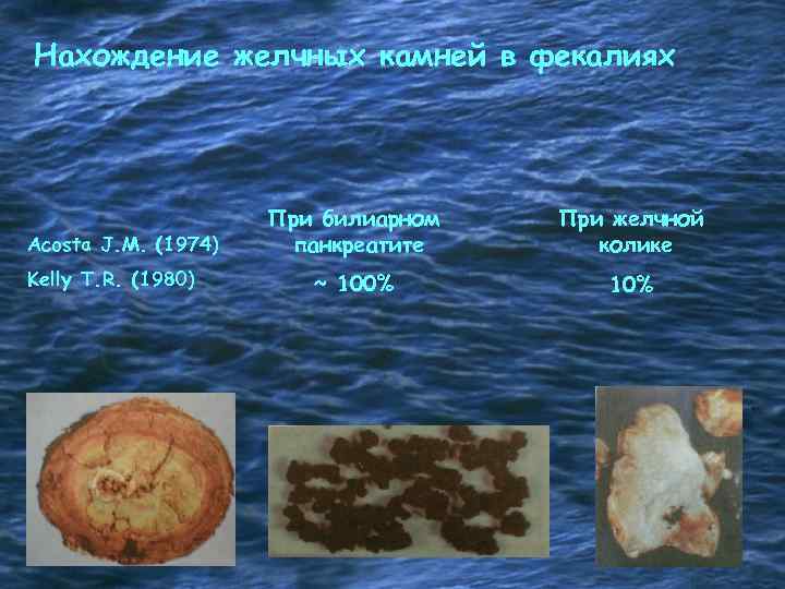 Нахождение желчных камней в фекалиях Acosta J. M. (1974) Kelly T. R. (1980) При