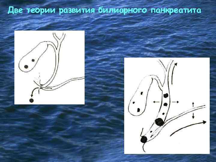 Две теории развития билиарного панкреатита 
