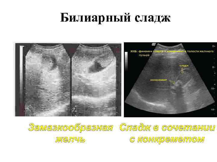 Билиарный сладж 