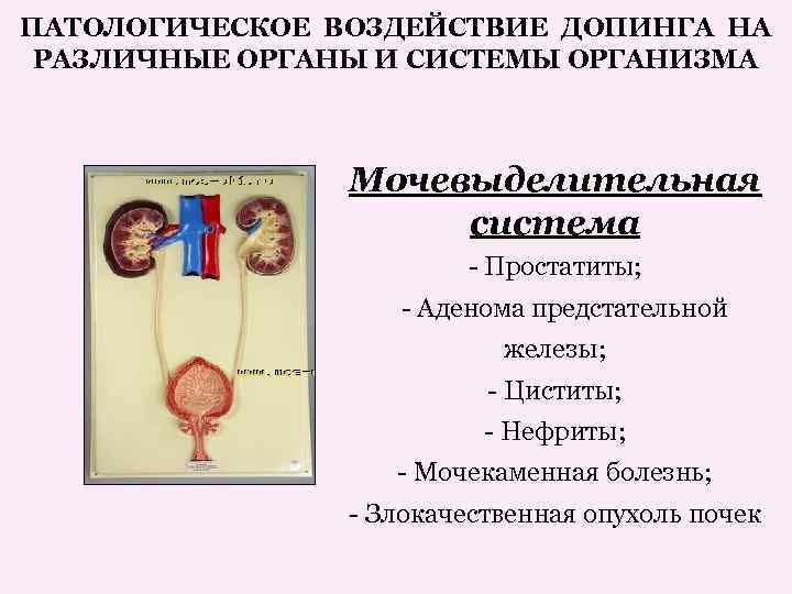 Цистит предстательной железы