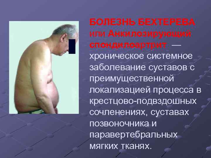БОЛЕЗНЬ БЕХТЕРЕВА или Анкилозирующий спондилоартрит — хроническое системное заболевание суставов с преимущественной локализацией процесса