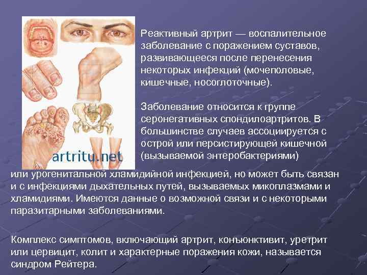 Реактивный артрит — воспалительное заболевание с поражением суставов, развивающееся после перенесения некоторых инфекций (мочеполовые,