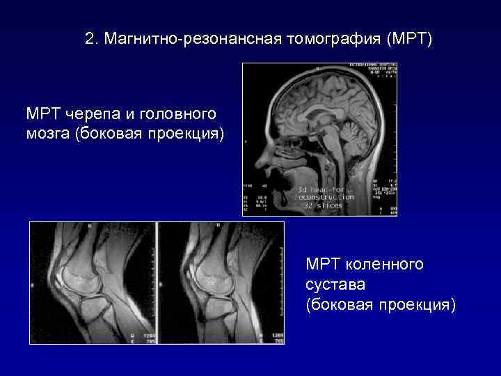 2. Магнитно-резонансная томография (МРТ) МРТ черепа и головного мозга (боковая проекция) МРТ коленного сустава