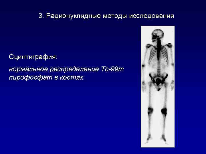 3. Радионуклидные методы исследования Сцинтиграфия: нормальное распределение Тс-99 m пирофосфат в костях 