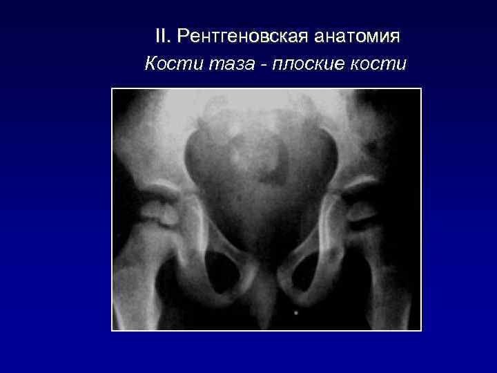 II. Рентгеновская анатомия Кости таза - плоские кости 