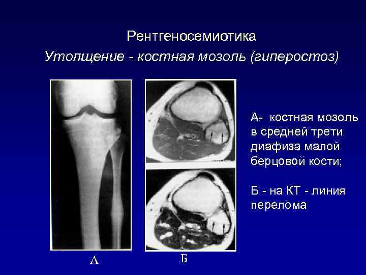 Рентгеносемиотика Утолщение - костная мозоль (гиперостоз) А- костная мозоль в средней трети диафиза малой