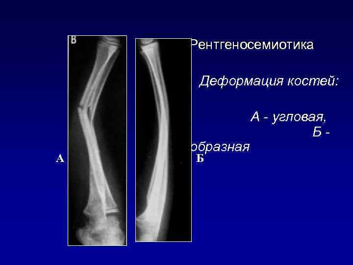 Рентгеносемиотика Деформация костей: А дугообразная Б А - угловая, Б- 