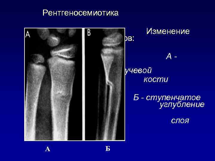 Рентгеносемиотика контуров: Изменение А- валикообразный выступ в лучевой кости Б - ступенчатое углубление ного