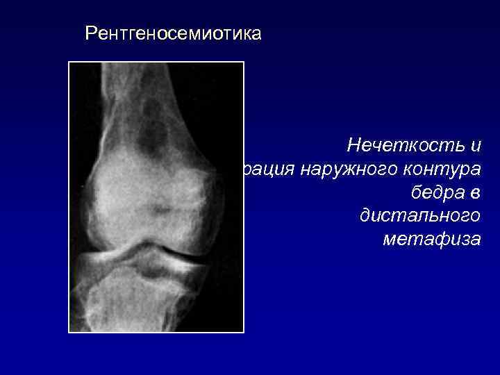 Рентгеносемиотика Нечеткость и узурация наружного контура бедра в области дистального метафиза 