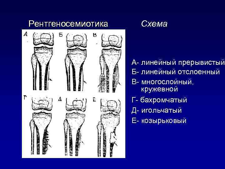 Рентгеносемиотика разновидностей периоститов: Схема А- линейный прерывистый Б- линейный отслоенный В- многослойный, кружевной Г-