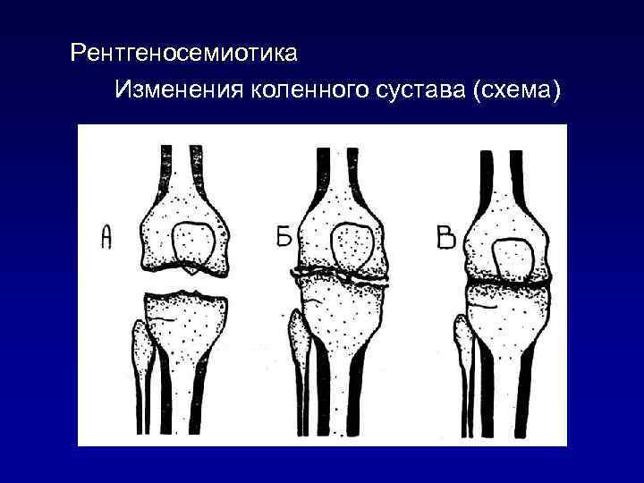 Рентгеносемиотика Изменения коленного суcтава (схема) 