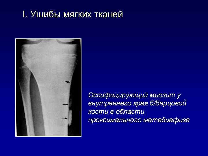 I. Ушибы мягких тканей Оссифицирующий миозит у внутреннего края б/берцовой кости в области проксимального