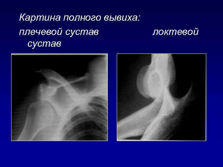 Картина полного вывиха: плечевой сустав локтевой 
