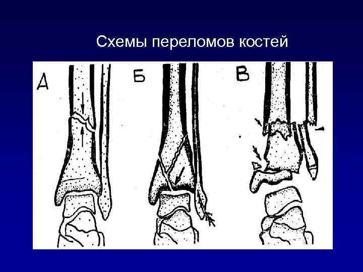 Схемы переломов костей 