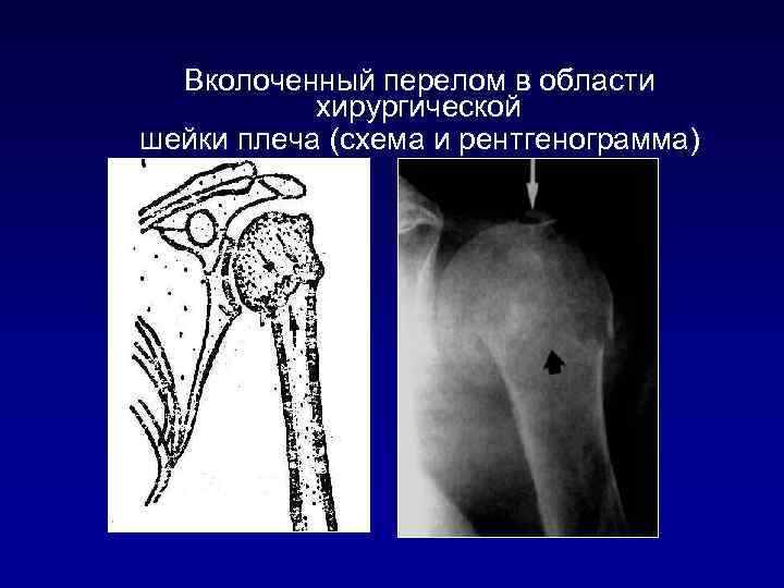 Вколоченный перелом в области хирургической шейки плеча (схема и рентгенограмма) 