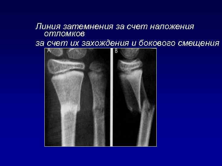 Линия затемнения за счет наложения отломков за счет их захождения и бокового смещения 