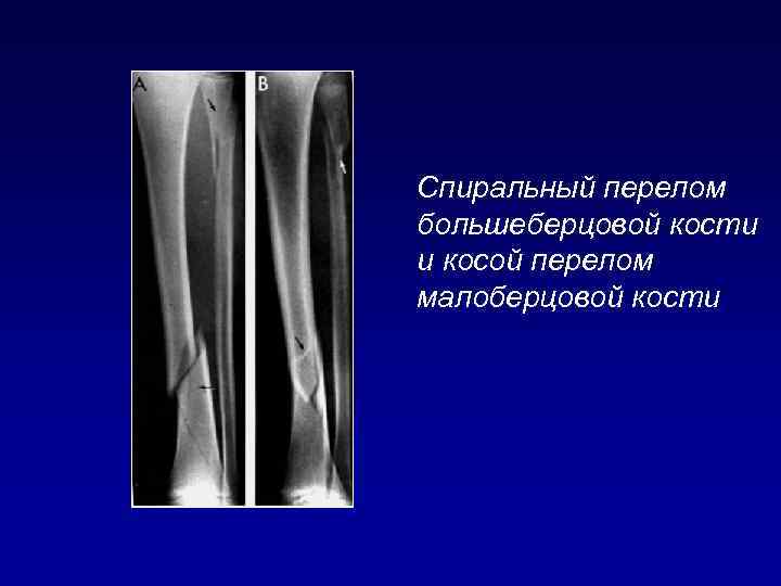 Спиральный перелом большеберцовой кости и косой перелом малоберцовой кости 