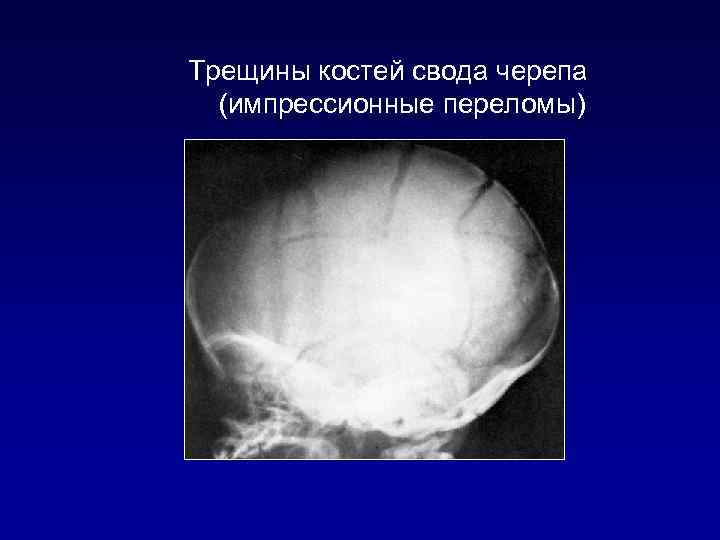 Трещины костей свода черепа (импрессионные переломы) 